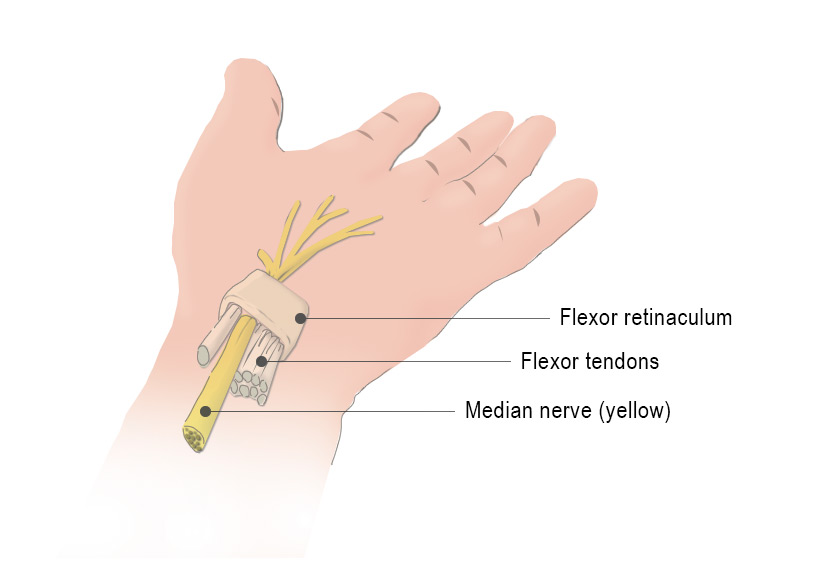 Carpal Tunnel Syndrome HAVS Health and Safety Hand Arm Vibration