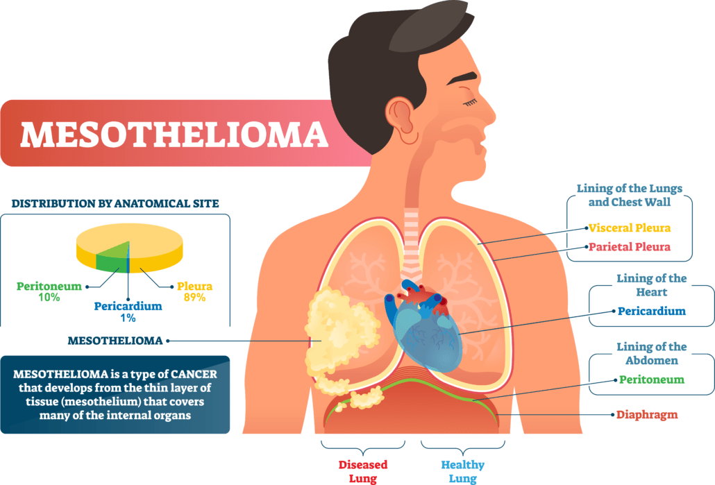 diagnosis of thoracic malignant mesothelioma