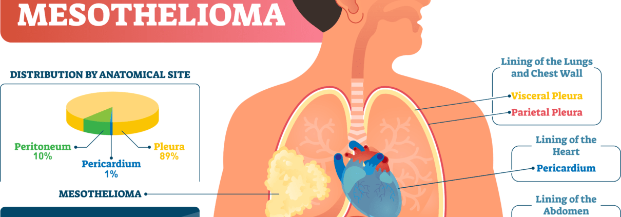 mesothelioma video assisted thoracoscopic