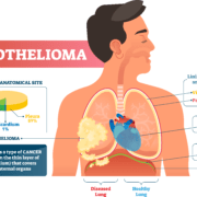 Mesothelioma Infographic