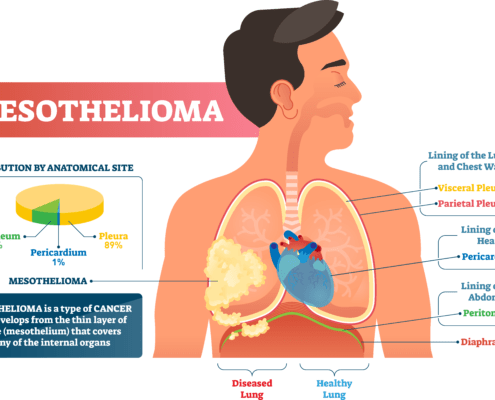 Mesothelioma Infographic